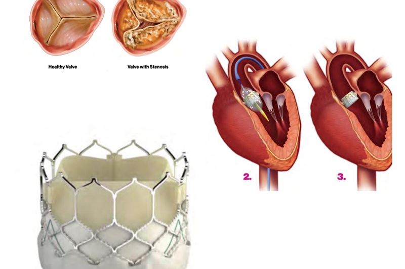 Implante de válvulas percutaneas en Nayarit